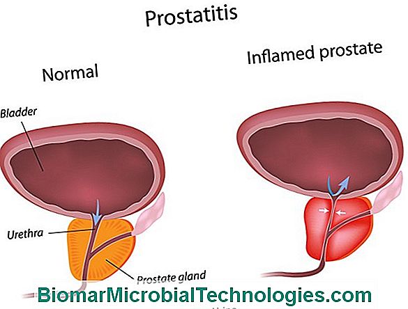 Prostatitis: Iscjeljivanje Biljkama